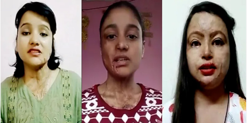 नेपालमा भएका डरलाग्दा एसिड आक्रमणहरू जसले युवतीको जीवन नै बर्बाद बनाएको थियो