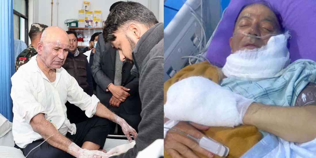 बेलुन फुटी जलेका अर्थमन्त्री पौडेल आजै डिस्चार्ज, मेयर आचार्य केही दिन अझै अस्पतालमा